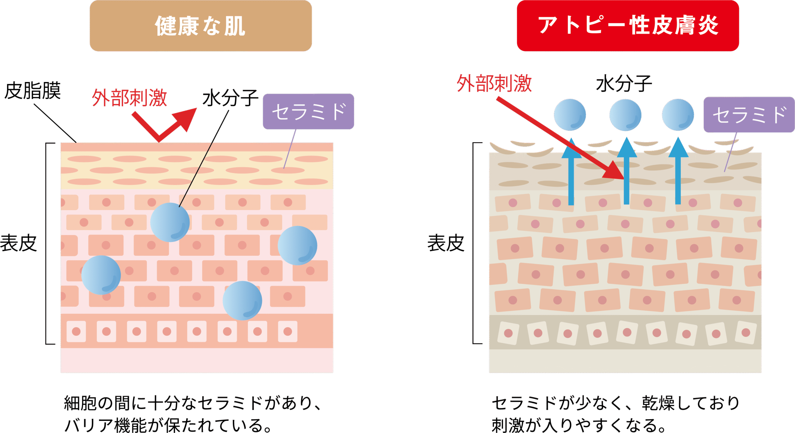 健康な肌とアトピー性皮膚炎の違い