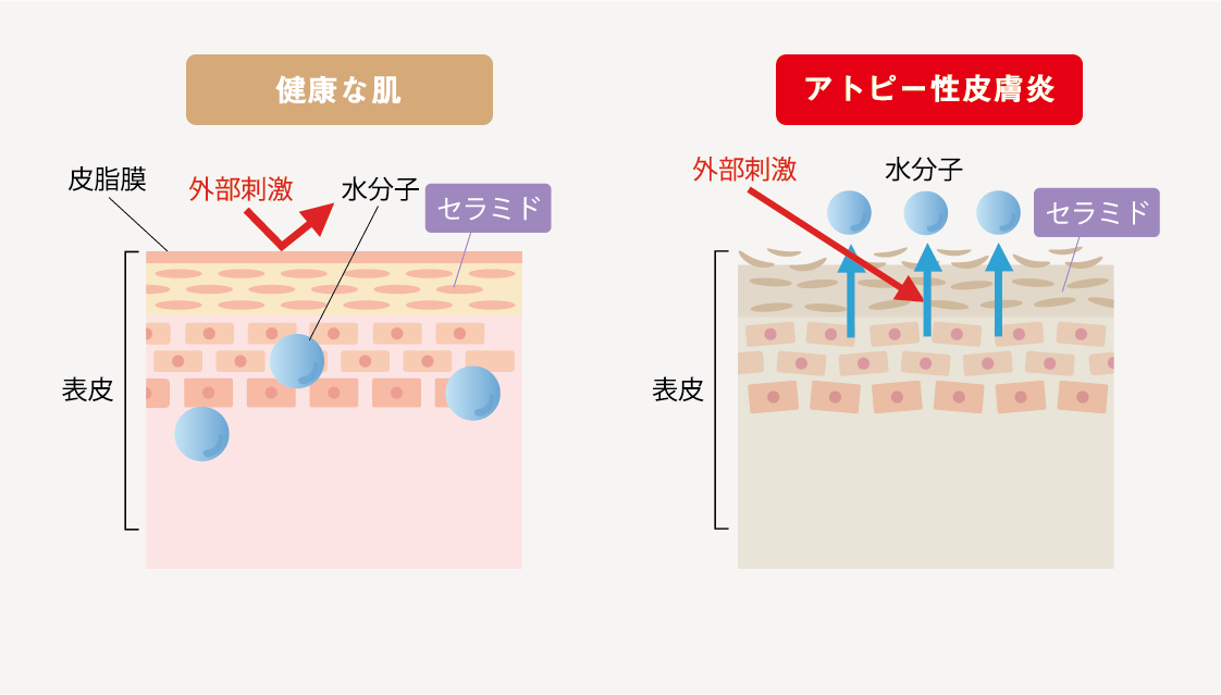 アトピー性皮膚炎の発症メカニズムの図