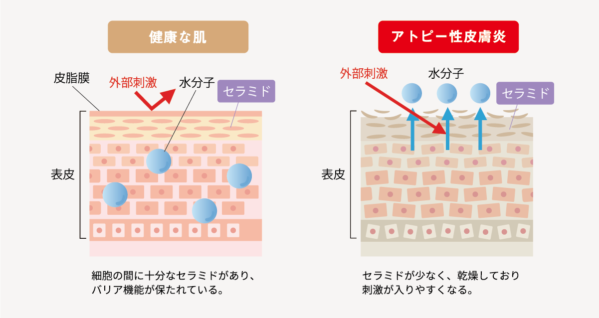 アトピー性皮膚炎の発症メカニズムの図